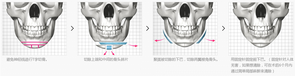 韩国下颌角整形术后的护理