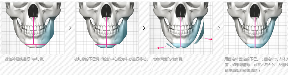 韩国下颌角整形术后的护理