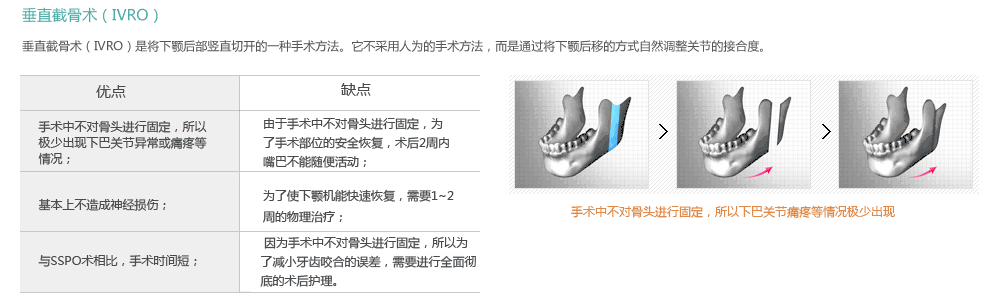 韩国地包天矫正手术哪里