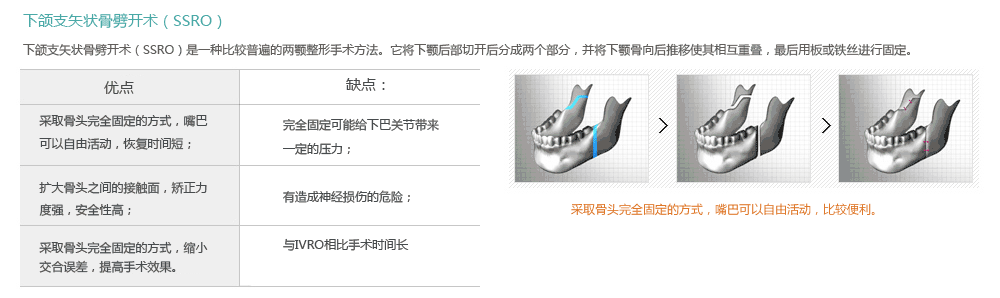 韩国哪里做地包天矫正手术好