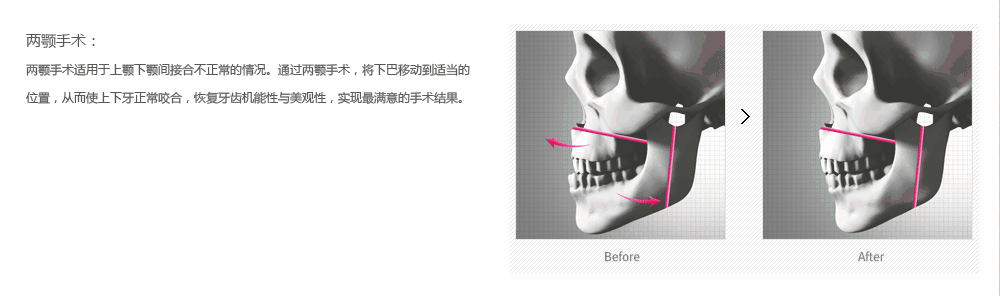 韩国地包天手术整形价格