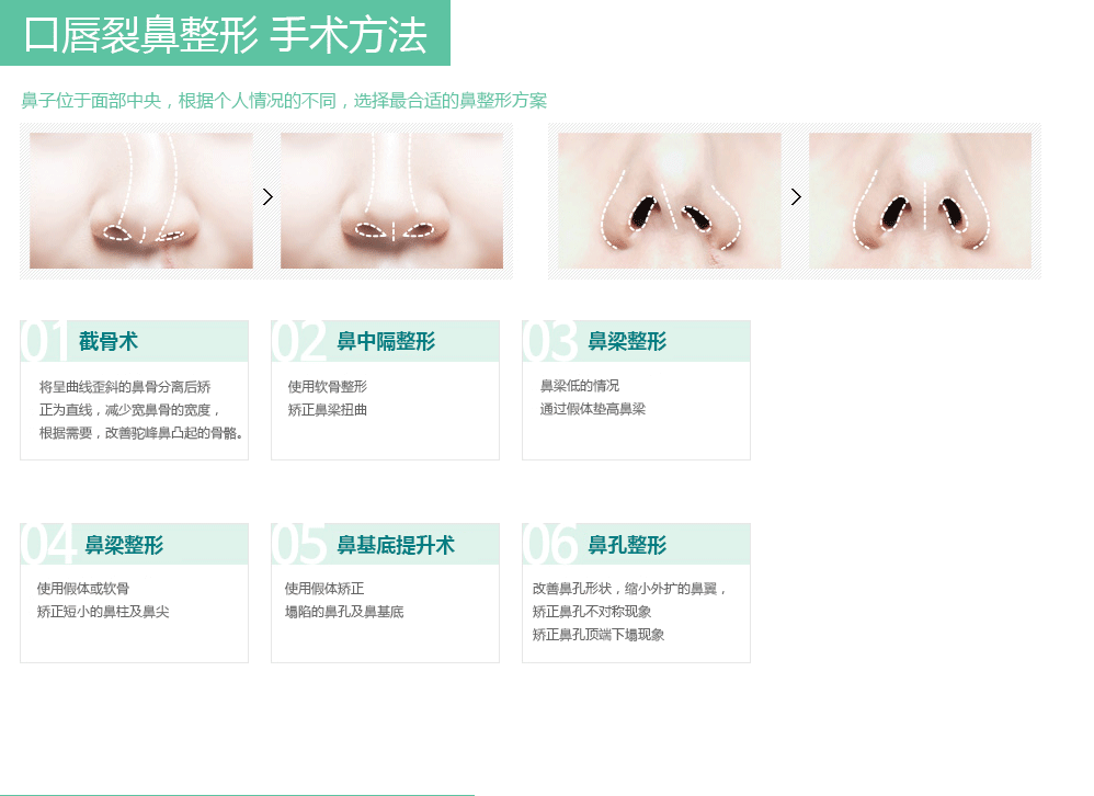 口唇裂鼻整形