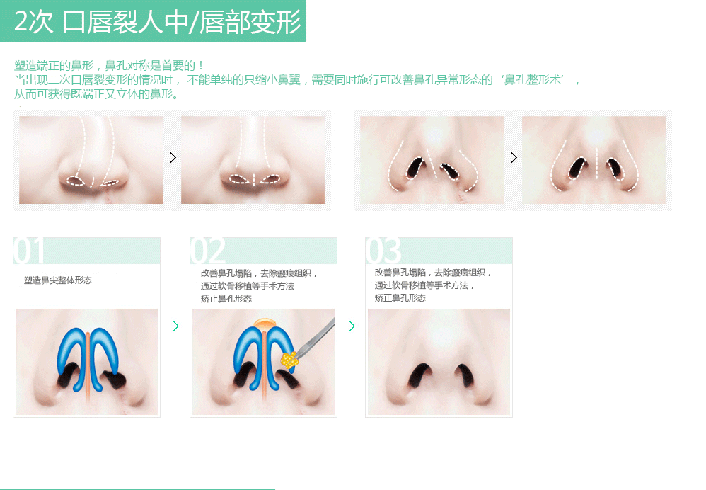 口唇裂鼻整形