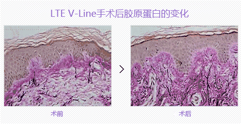 眼部提升手术