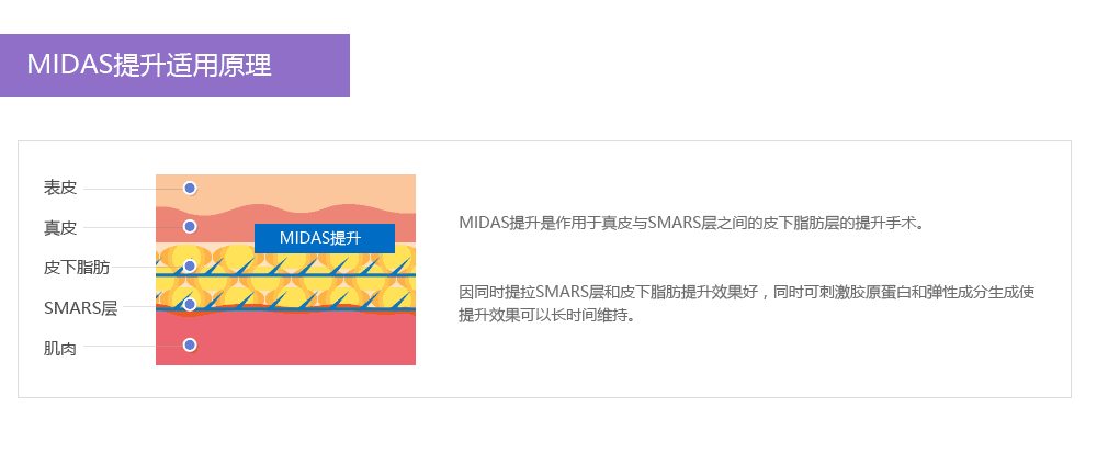 MIDAS提升术优势