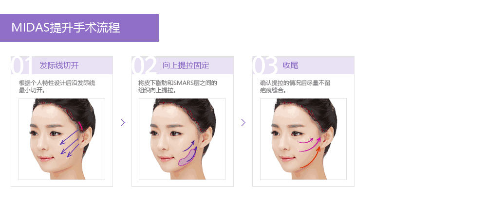 MIDAS提升术面部提升优势