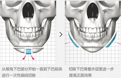 韩国面部轮廓手术的费用