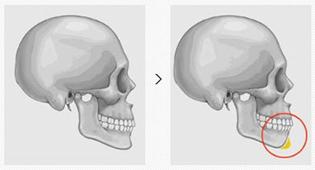 韩国下巴整形哪里效果好
