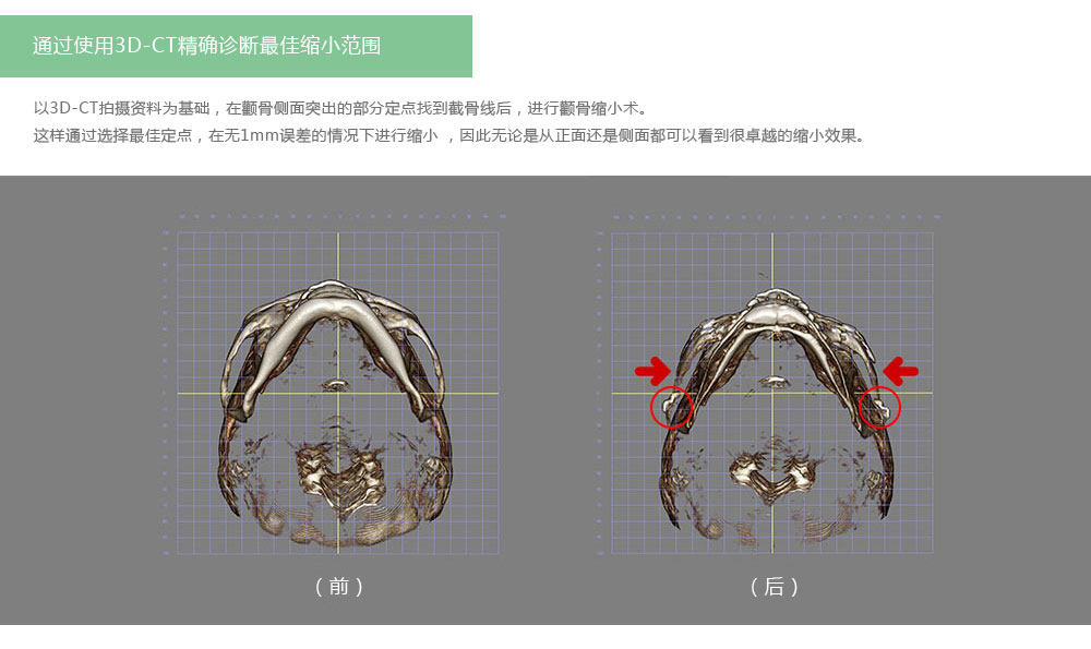 通过使用3D-CT精确诊断最佳缩小范围