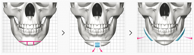 韩国下巴整形手术的过程