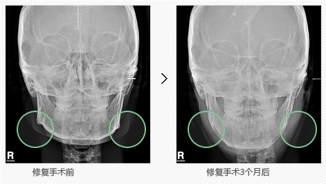 韩国脸部修复整形哪里效果好