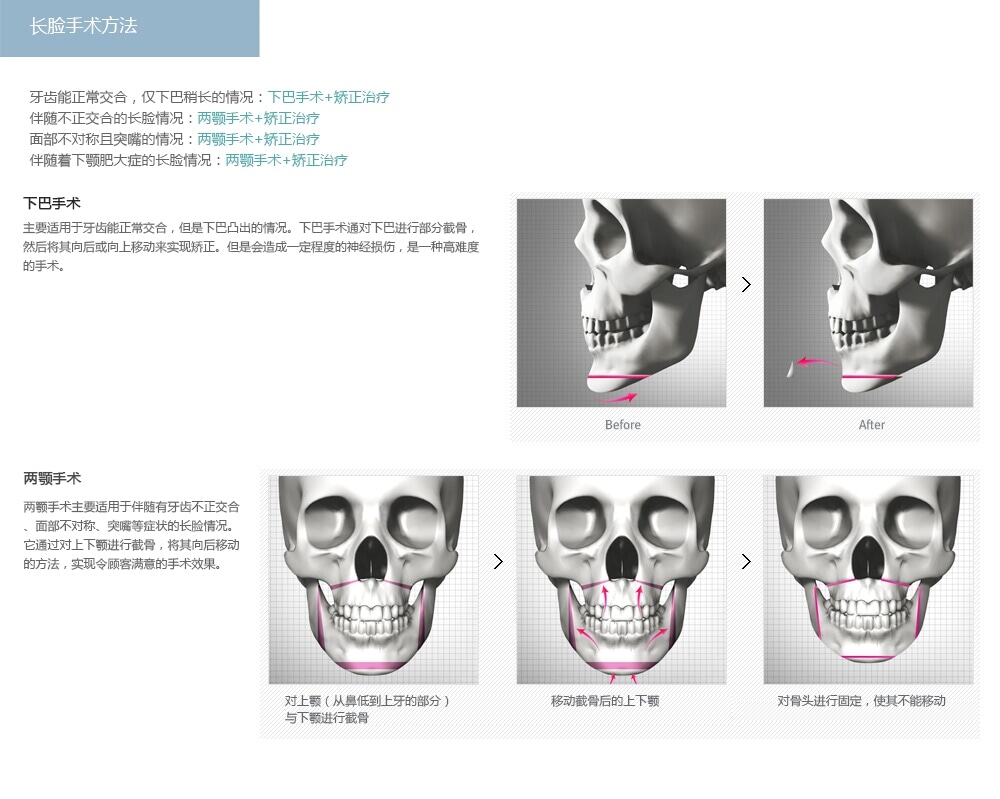 韩国长脸手术哪家比较好