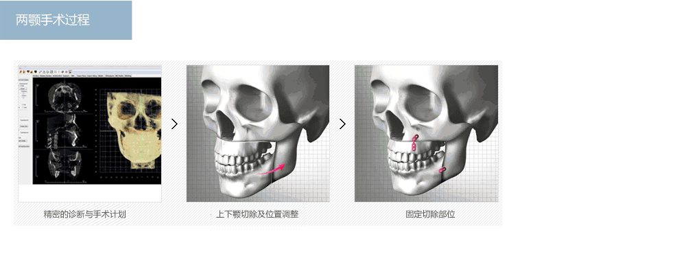 韩国两鄂手术哪家医院好