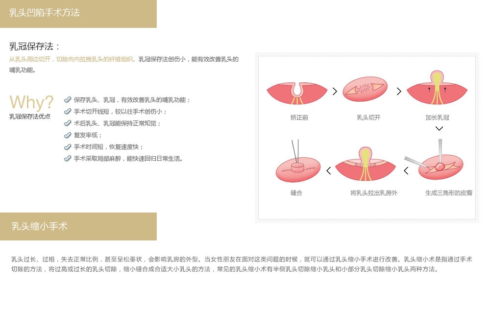 韩国乳头塑形医院