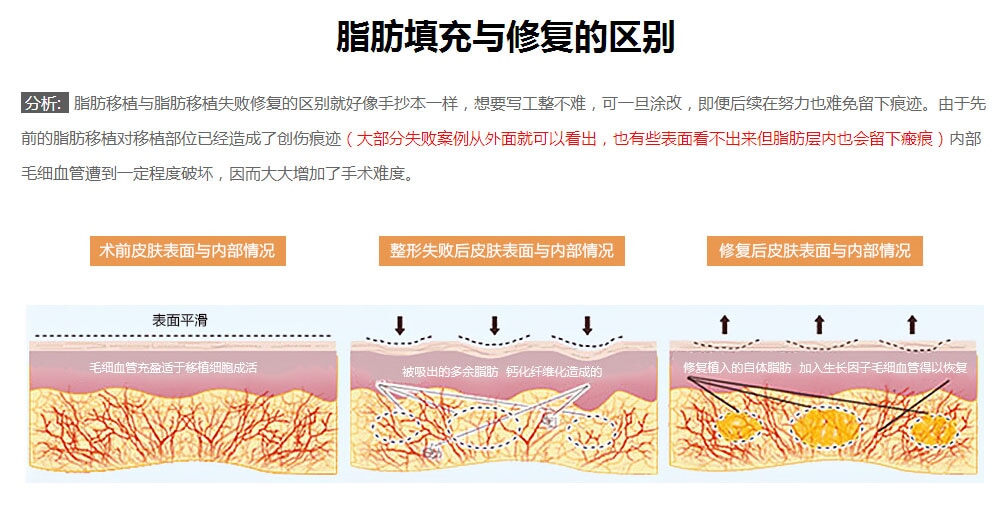 韩国隆胸失败修6