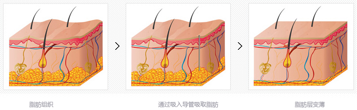 韩国原辰吸脂手术多少钱？